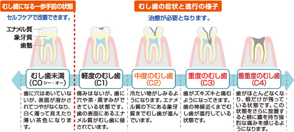 むし歯の進行の様子